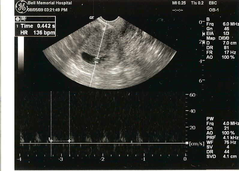 Ultrasound Heartbeat (August 5, 2009)