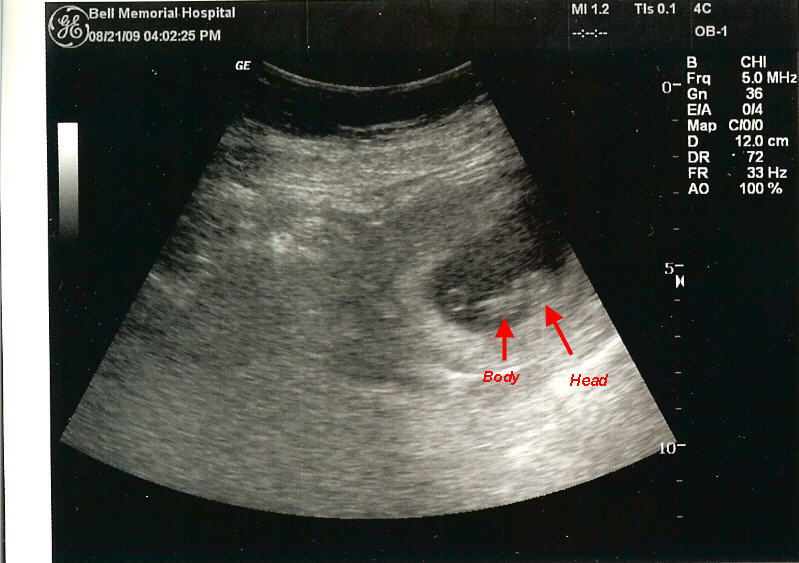 Ultrasound (August 21, 2009)
