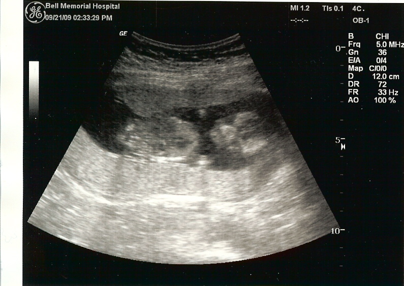 Ultrasound 14 Weeks (September 21, 2009)